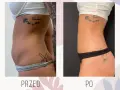 Liposukcja: Co to jest? Metody, efekty, cena i rekonwalescencja