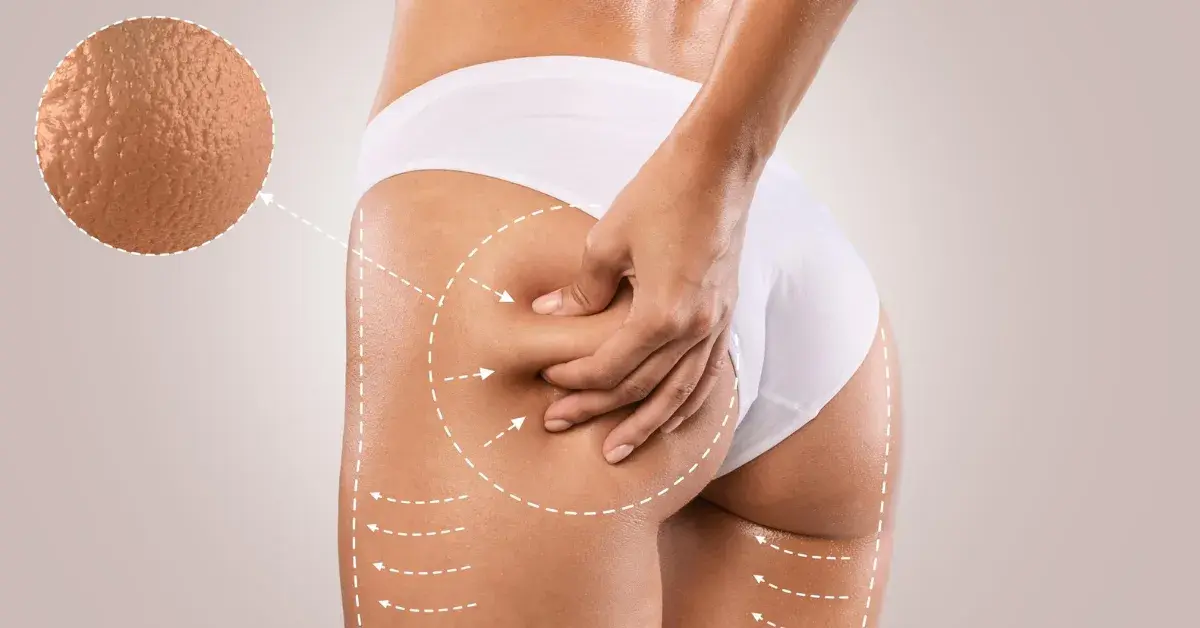 Endermologia vs Liposukcja Kawitacyjna: Który zabieg wybrać?