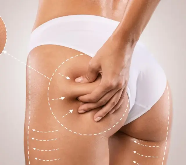 Endermologia vs Liposukcja Kawitacyjna: Który zabieg wybrać?