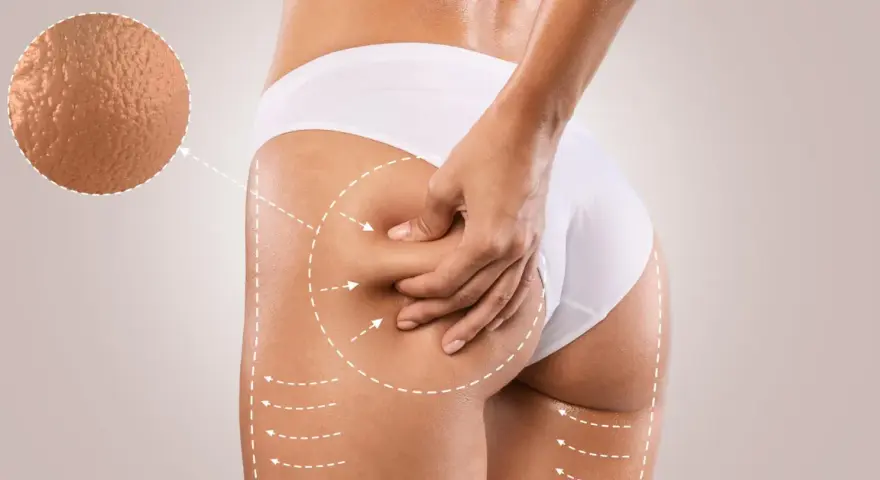 Endermologia vs Liposukcja Kawitacyjna: Który zabieg wybrać?